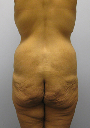 Buttock Lift Before & After Image