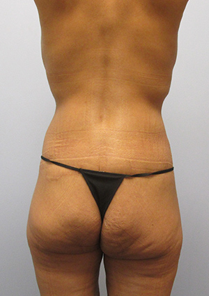 Buttock Lift Before & After Image