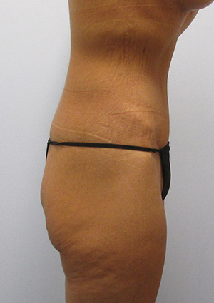 Buttock Lift Before & After Image