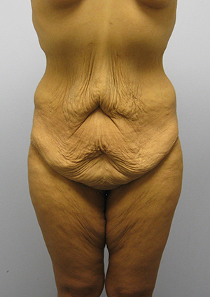 Buttock Lift Before & After Image