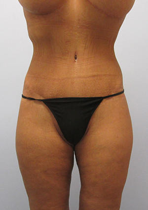 Buttock Lift Before & After Image