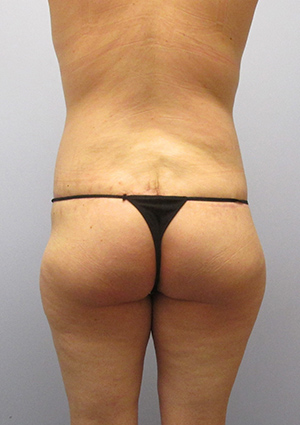 Buttock Lift Before & After Image