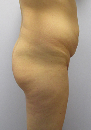 Buttock Lift Before & After Image