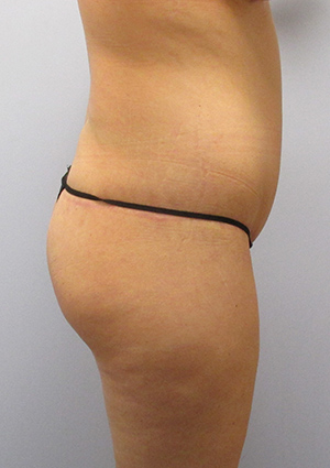 Buttock Lift Before & After Image