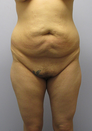 Buttock Lift Before & After Image