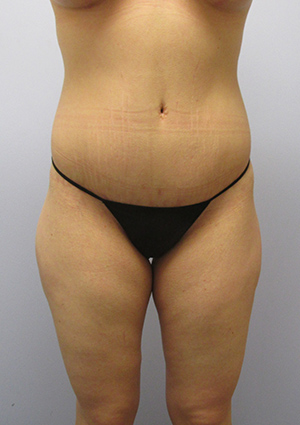 Buttock Lift Before & After Image