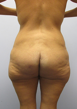 Buttock Lift Before & After Image