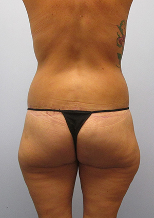 Buttock Lift Before & After Image