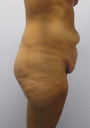 Buttock Lift Before & After Image