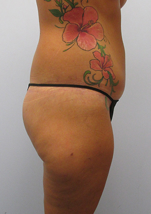 Buttock Lift Before & After Image