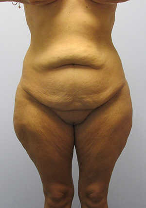 Buttock Lift Before & After Image