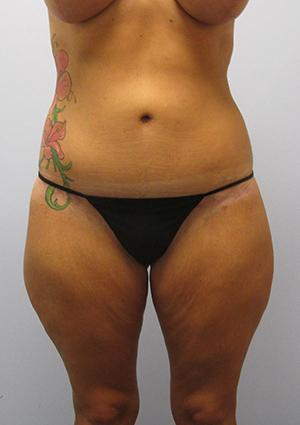 Buttock Lift Before & After Image