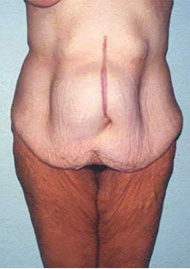 Buttock Lift Before & After Image