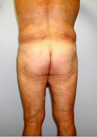 Buttock Lift Before & After Image