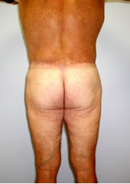 Buttock Lift Before & After Image