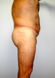 Buttock Lift Before & After Image