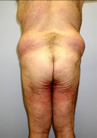 Buttock Lift Before & After Image