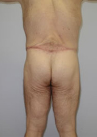 Buttock Lift Before & After Image