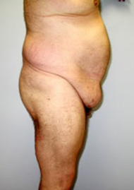 Buttock Lift Before & After Image