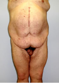 Buttock Lift Before & After Image