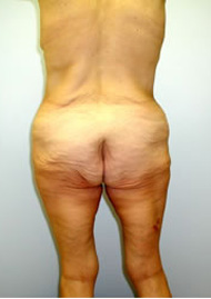 Buttock Lift Before & After Image