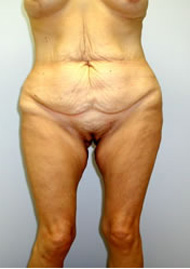 Buttock Lift Before & After Image