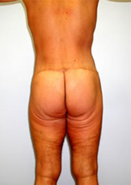 Buttock Lift Before & After Image