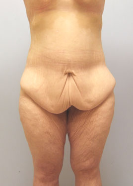 Buttock Lift Before & After Image