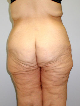 Buttock Lift Before & After Image