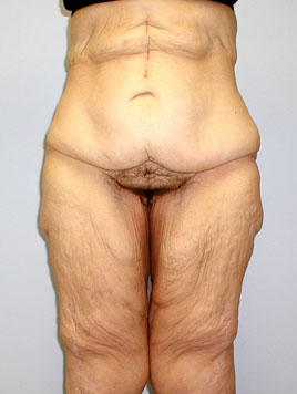 Buttock Lift Before & After Image