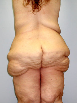 Buttock Lift Before & After Image