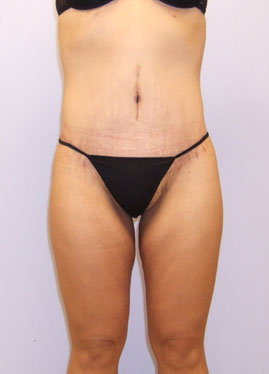 Buttock Lift Before & After Image