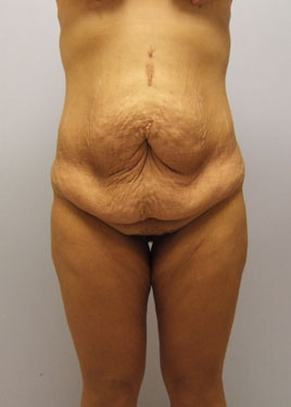 Buttock Lift Before & After Image