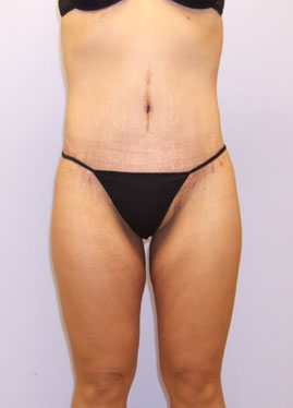 Buttock Lift Before & After Image