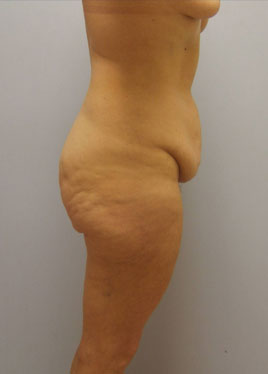 Buttock Lift Before & After Image