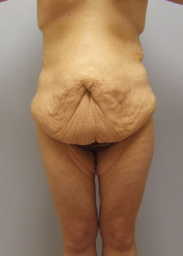 Buttock Lift Before & After Image