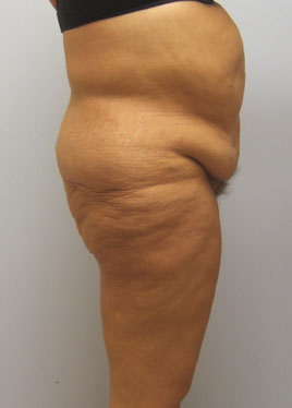 Buttock Lift Before & After Image