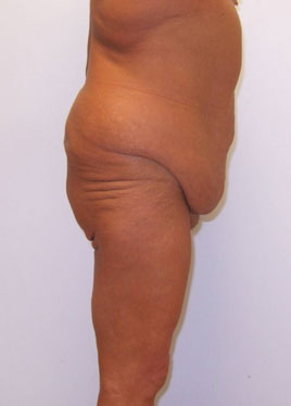 Buttock Lift Before & After Image