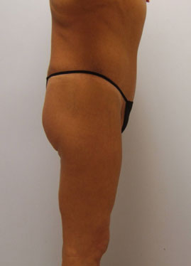 Buttock Lift Before & After Image