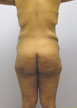 Buttock Lift Before & After Image