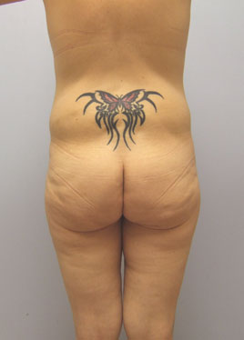 Buttock Lift Before & After Image