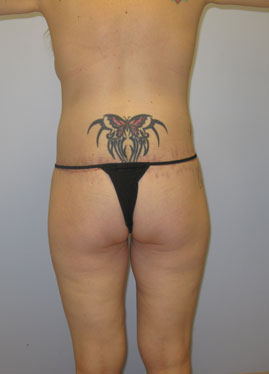 Buttock Lift Before & After Image