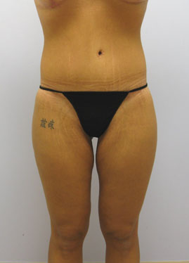 Buttock Lift Before & After Image