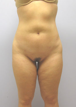 Buttock Lift Before & After Image