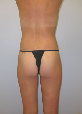 Buttock Lift Before & After Image