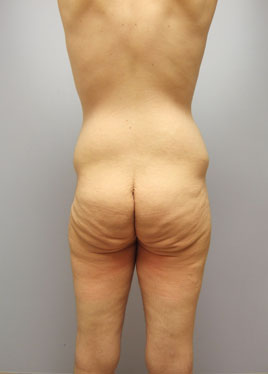 Buttock Lift Before & After Image