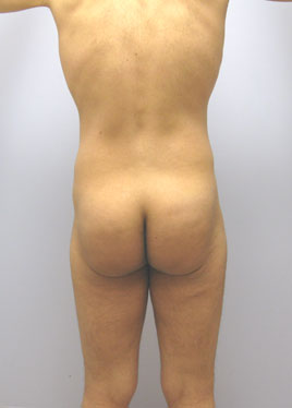 Buttock Lift Before & After Image