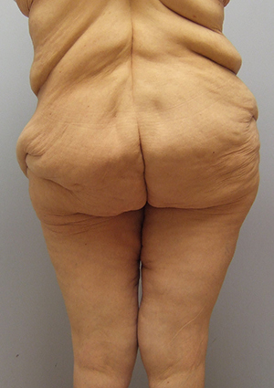 Buttock Lift Before & After Image