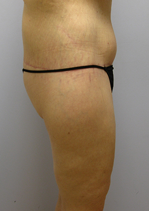 Buttock Lift Before & After Image