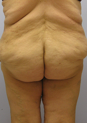 Buttock Lift Before & After Image